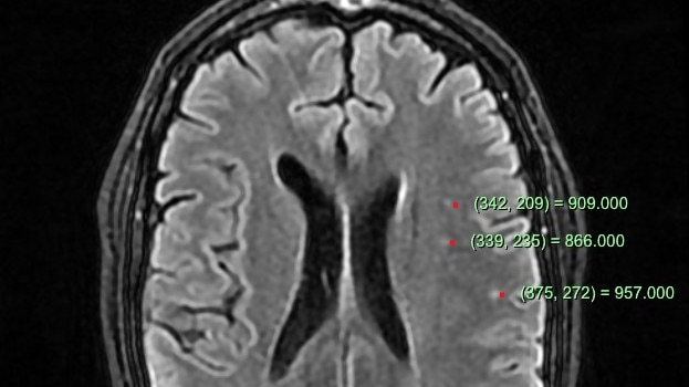 Brain scans revealed lesions in James Graham’s brain.