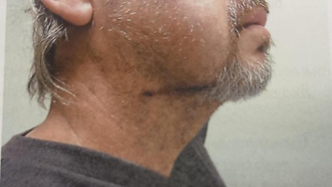 The bullet wound across Mr Uskovic’s neck is visible after he was shot by Murrell in the front of his Wahroonga home. Picture: Supplied