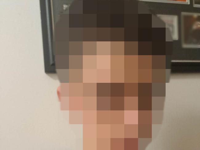 The mum of Connor Harding, 16 has sent through photos of her son's injuries as it progressed Picture: Supplied