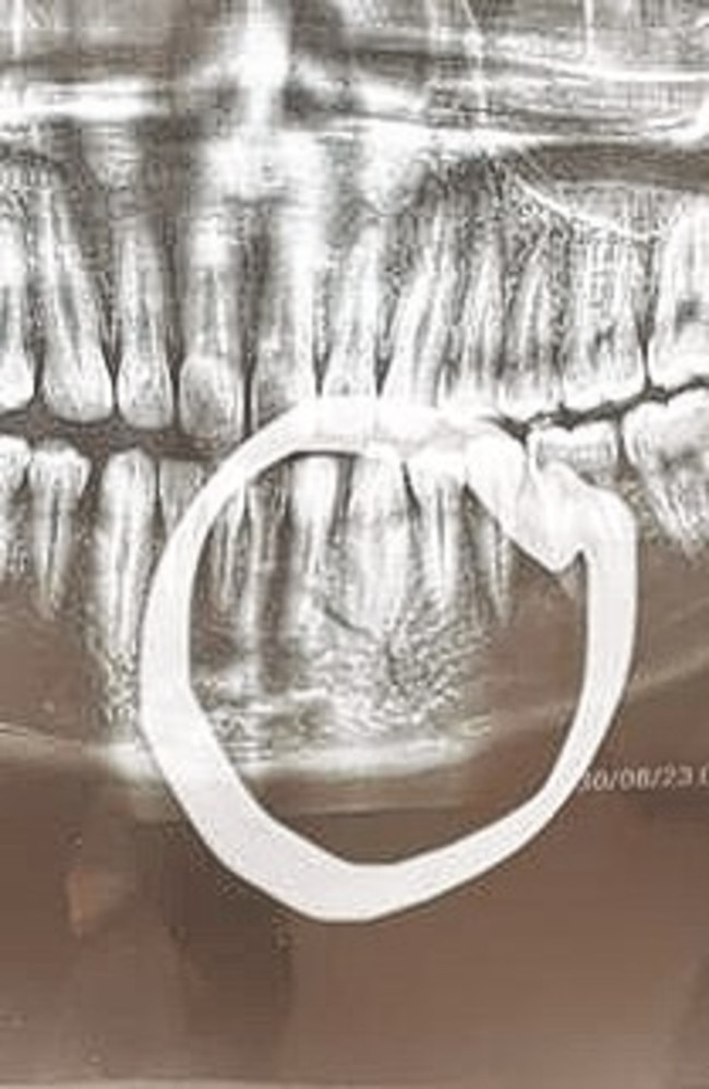 X-Ray image of Paulo Aokuso's jaw.