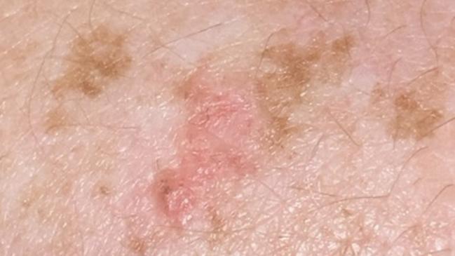 While it does not provide a diagnosis the app can help people decide whether to visit a doctor to get their skin checked. Picture: Supplied