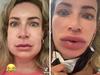 Woman’s horror reaction to lip filler