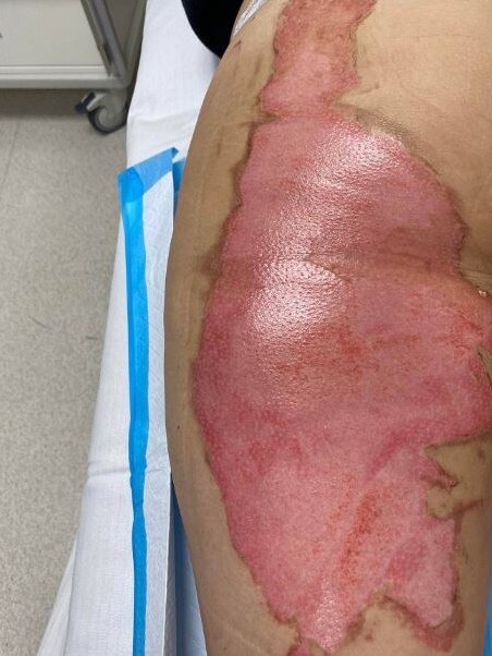 It's not clear yet whether skin grafts will be needed. Picture: Supplied