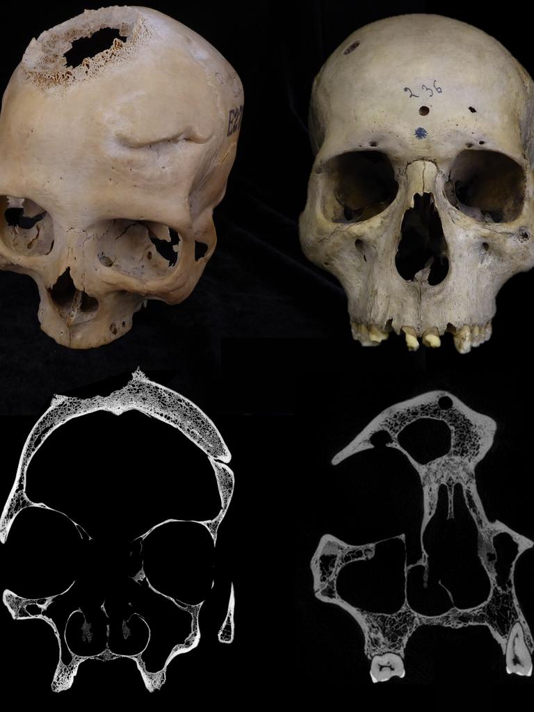 The two skulls that were studied. Picture: Dr Edgard Camaros
