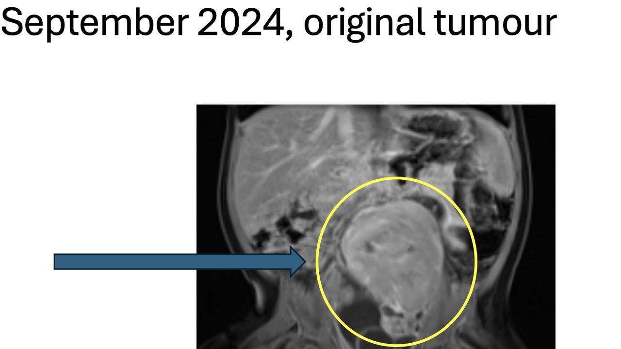 Scans show Flynn’s tumour at the beginning of treatment.