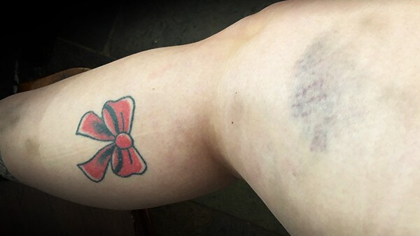 Alicia's bruised leg, which she claims happened during the alleged incident.