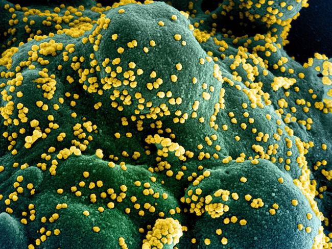 (FILES) In this undated handout image obtained July 15, 2020, courtesy of National Institute of Allergy and Infectious Diseases(NIH/NIAID), shows a colorized scanning electron micrograph of an apoptotic cell (blue/green) heavily infected with SARS-COV-2 virus particles (yellow), isolated from a patient sample, captured at the NIAID Integrated Research Facility (IRF) in Fort Detrick, Maryland. - US pharmaceutical company Eli Lilly's combination of two synthetic antibodies against Covid-19 reduced hospitalizations and deaths by 70 percent in high-risk patients with recent positive tests, the company said on January 26, 2021. "Bamlanivimab and etesevimab together have the potential to be an important treatment that significantly reduces hospitalizations and death in high-risk COVID-19 patients," Lilly's chief scientific officer Daniel Skovronsky said. (Photo by Handout / National Institute of Allergy and Infectious Diseases / AFP) / RESTRICTED TO EDITORIAL USE - MANDATORY CREDIT "AFP PHOTO /NATIONAL INSTITUTE OF ALLERGY AND INFECTIOUS DISEASES/HANDOUT " - NO MARKETING - NO ADVERTISING CAMPAIGNS - DISTRIBUTED AS A SERVICE TO CLIENTS