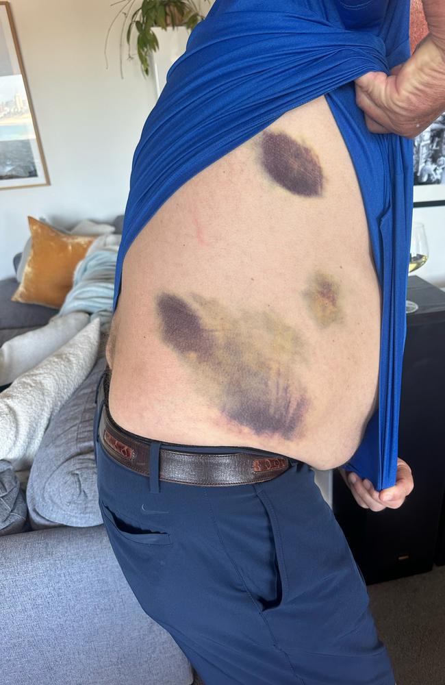 Botham's bruised body after falling into the river in Darwin.