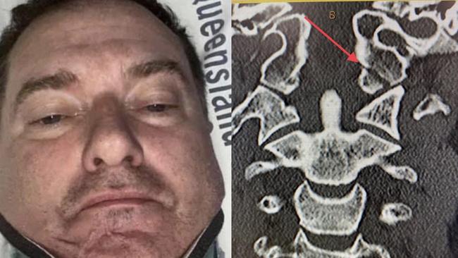 Wide Bay MP Llew O'Brien was injured in a motorbike accident. The X-ray shows an occipital fracture.