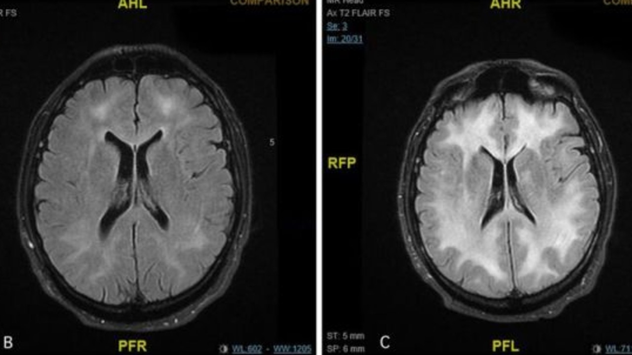 Doctors Release Scans Of Brain Showing Effects Of Cocaine Use 