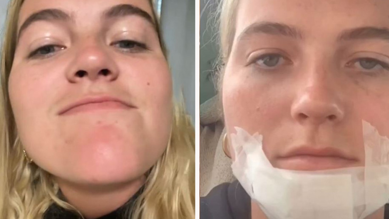 Woman develops staph infection after kissing man with stubble The