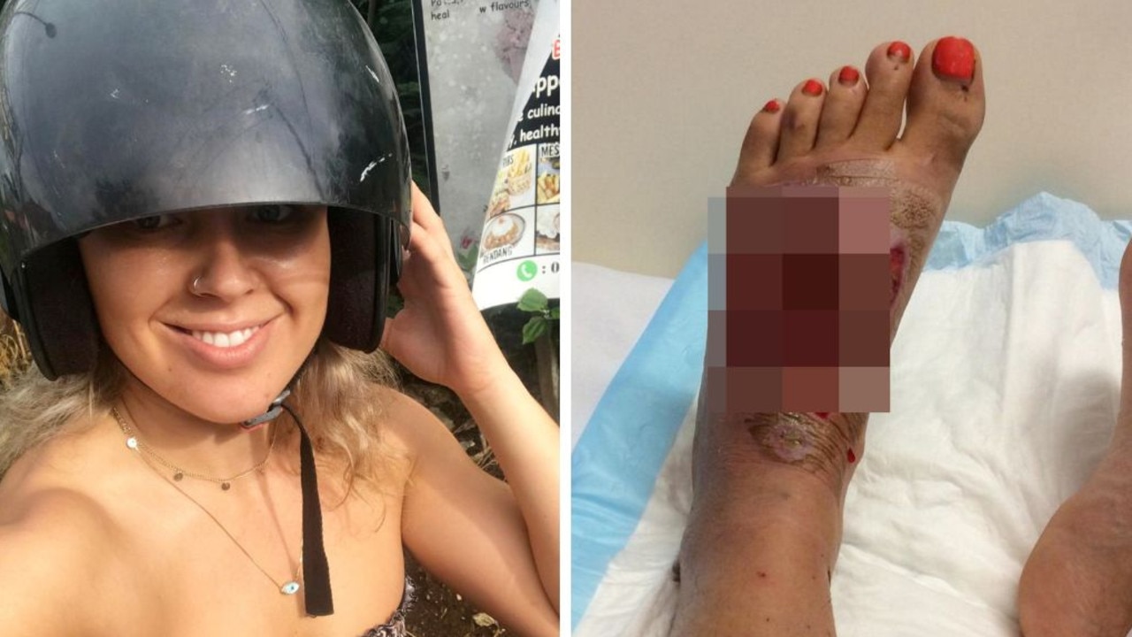 Woman’s foot impaled after horror Bali crash