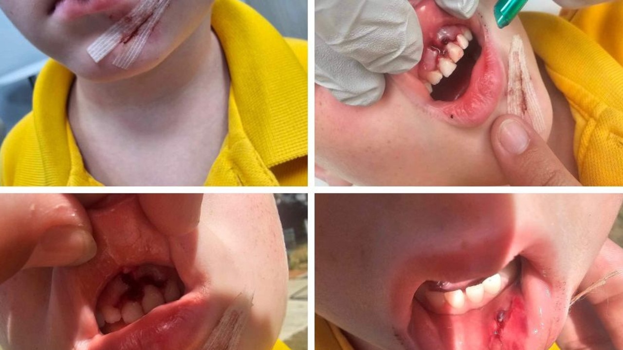 Prep student Xander had emergency dental surgery to remove the teeth stuck in his gum as a result of his playground accident on March 5, 2024.