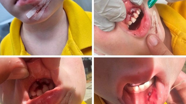 Prep student Xander had emergency dental surgery to remove the teeth stuck in his gum as a result of his playground accident on March 5, 2024.