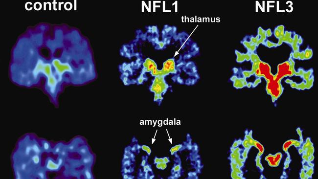 The left image shows a normal brain scan and the middle and right images show scans of pro football players.