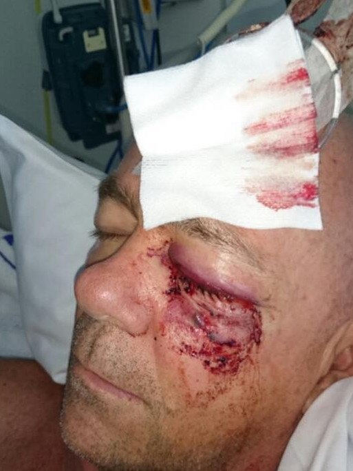 Eye injury sustained by Cleveland Youth Detention Centre worker Grant Oaklands, 55, during November 10 riot. SUPPLIED