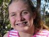 Brain stem cells offer new hope for cerebral palsy