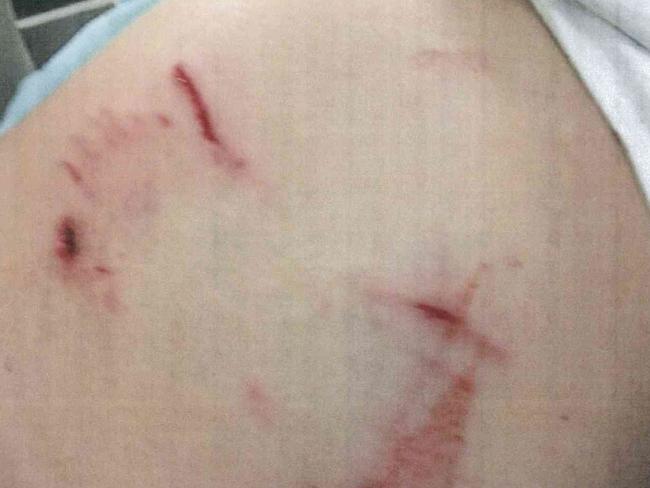 Photos showing a woman's injuries allegedly sustained by a bite from Sarge the staffy. Source: Moreton Bay Regional Council