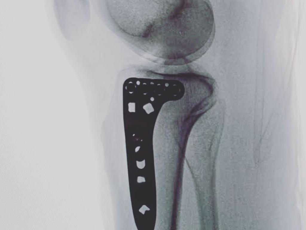 Ouch. Leila shared an X-ray of her knee.