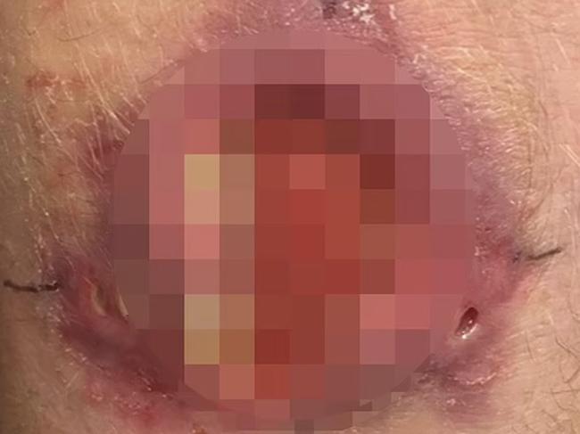 Vic hit with flesh-eating ulcer outbreak