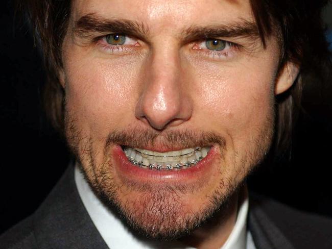 Actor Tom Cruise at the London premiere of his film Minority Report Jun 26, 2002. (AP PicMyung/Jung/Kim) pulling face braces teeth headshot