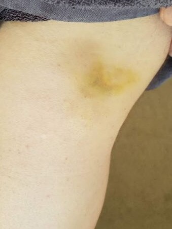 Bruising sustained by cyclist Alex Gardner.