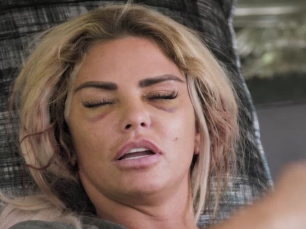 Katie Price after getting cosmetic surgery. Picture: Quest Red