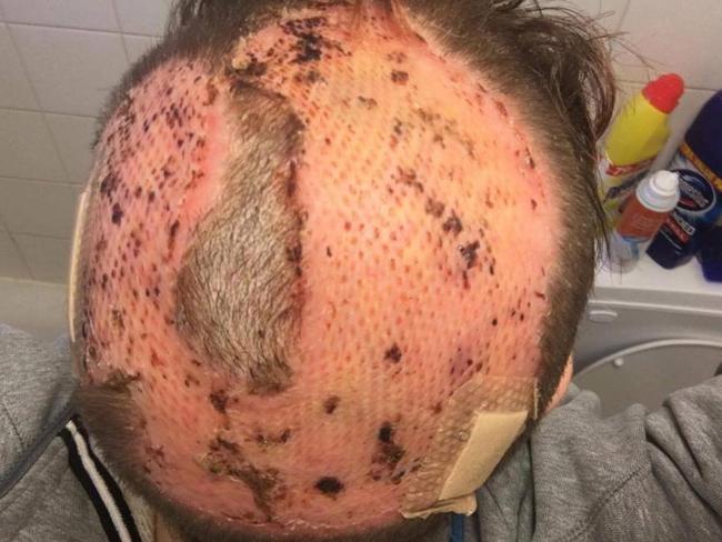 This was Kirsty's head a few weeks after doctors changed her bandages for the first time following her skin graft operation. Picture: PA/Real Life