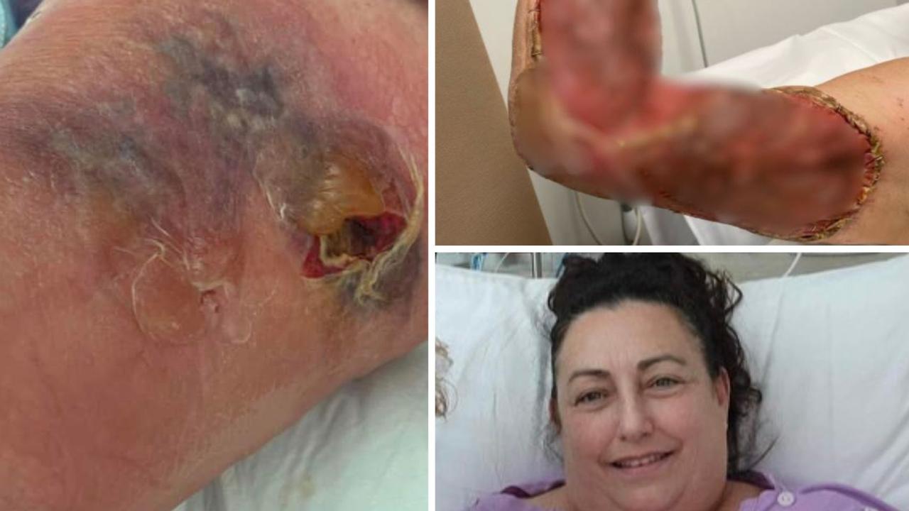 Ocean bacteria infection victims plead for Sunshine Coast Health investigation as cases double