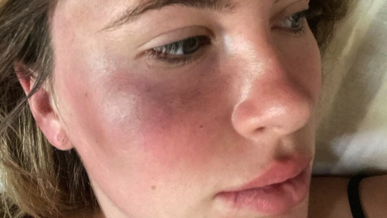 Ireland Baldwin, model daughter of Kim Basinger and Alec Baldwin, shocked fans by sharing some gnarly photos of her bruised and swollen face after she was allegedly attacked in a parking lot. Picture: Instagram/@irelandbasingerbaldwin