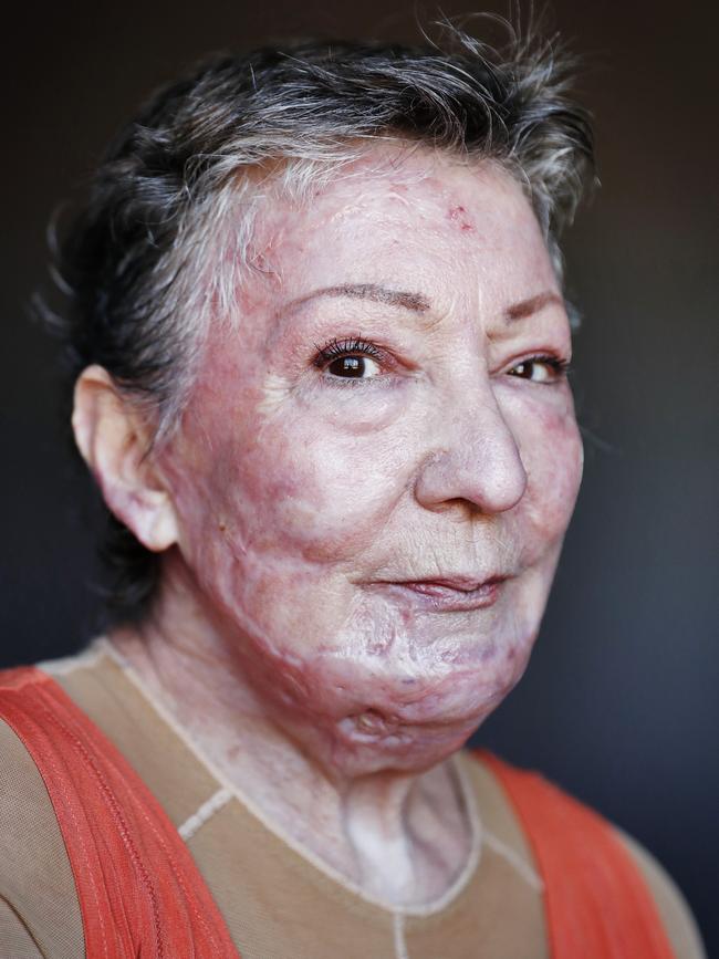 June Frew suffered burns to her face and body. Picture: Sam Ruttyn