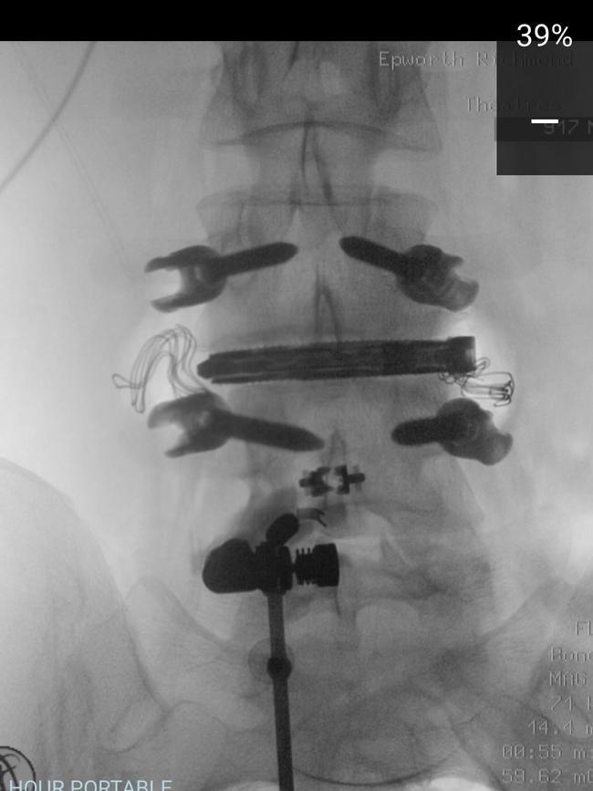 An X-ray of Sara Blicavs' back after spinal surgery.