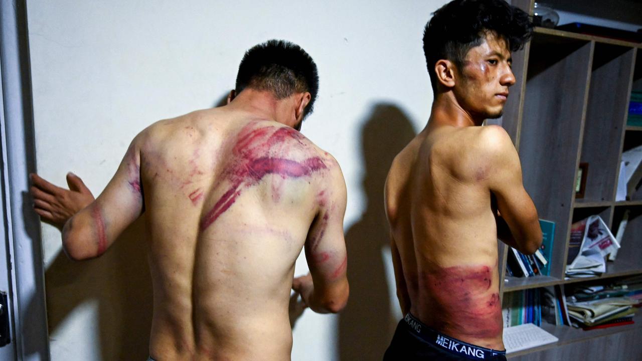 Etilaat Roz journalists Nematullah Naqdi and Taqi Daryabi show their injuries after the Taliban beating. Picture: Wakil Kohsar/AFP