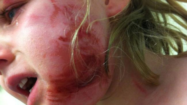 Virgin Atlantic Pays Huge Compensation To Girl Burnt By Airbag Herald Sun 2640