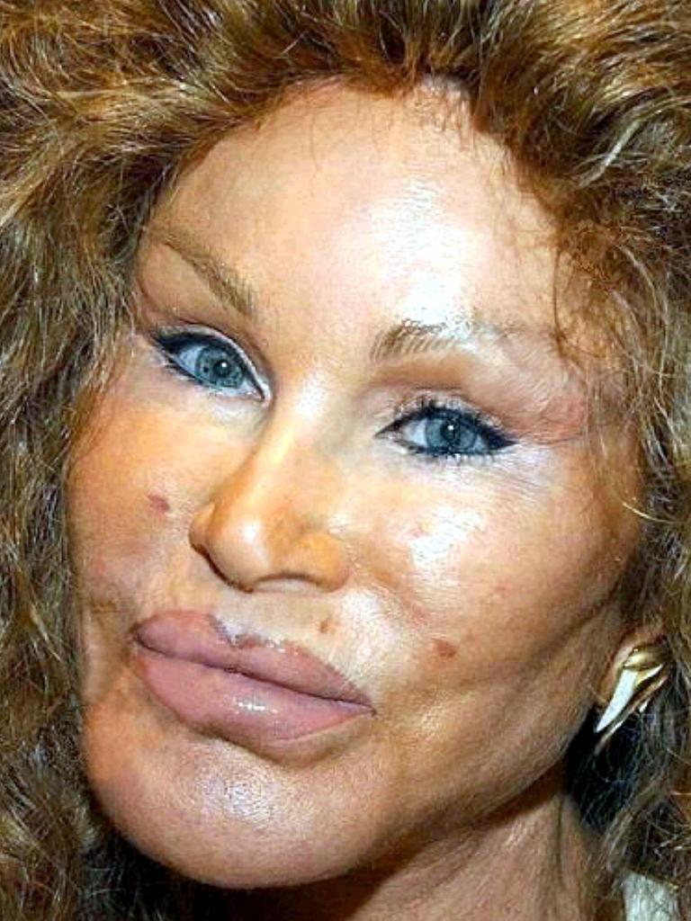 The most extreme plastic surgery addicts in the world - from a