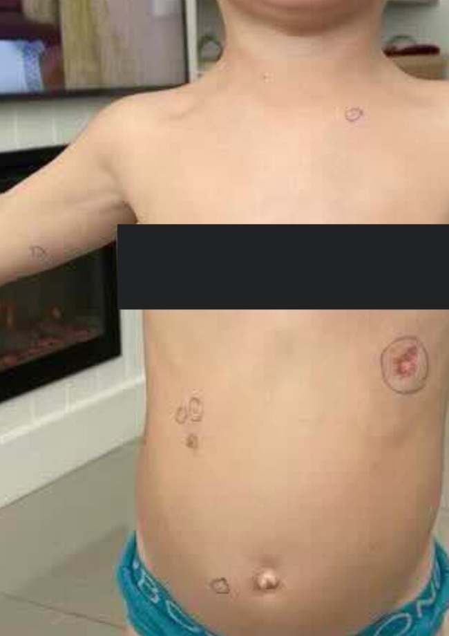 Also circled, was a birthmark - considered a potential infectious disease - that the child has had for the last two and a half years of attending Edge Early Learning. Picture. Picture: Supplied