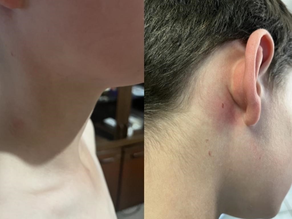 Photos of injuries sustained by a Victorian student with autism, ADHD and dyslexia due to bullying from other students.