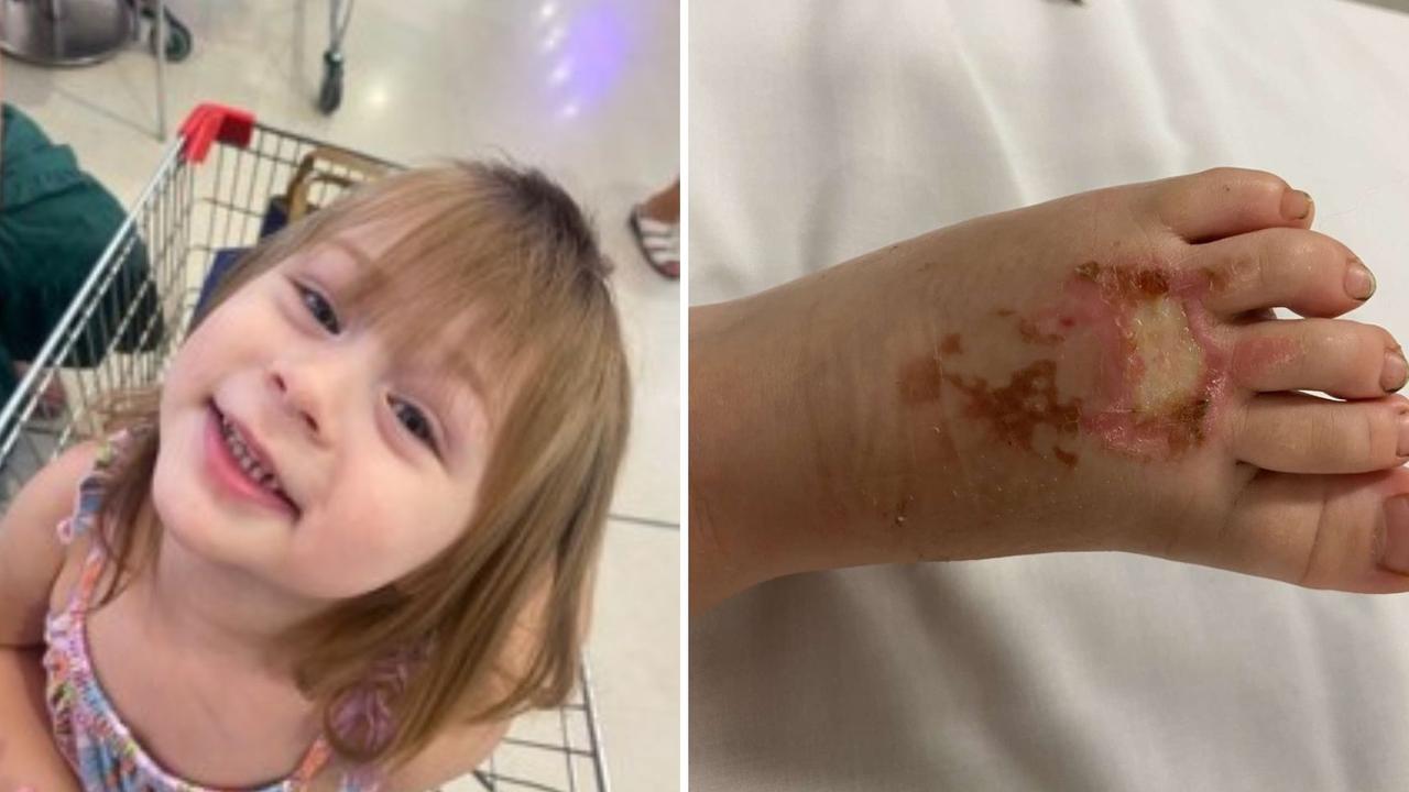 Council ‘deeply sorry’ after toddler suffers skin melting burns on slide