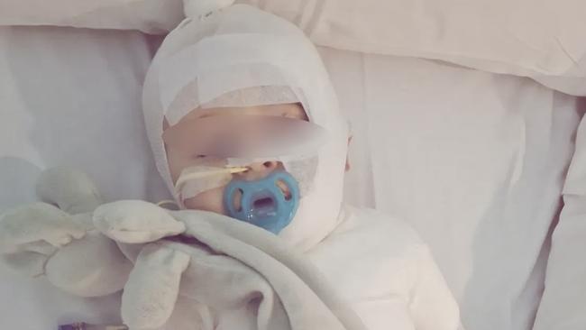 The mother of a baby Luka,, burned by coffee in a shocking random attack in a Brisbane park has shared an incredible update as her son faces his third surgery. Picture: Supplied ,