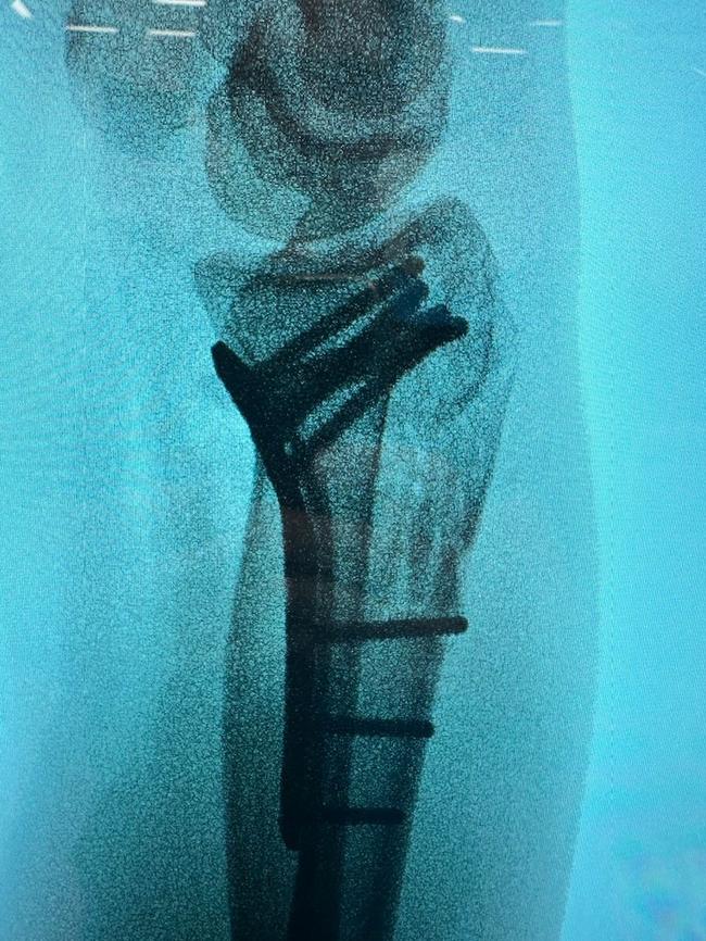 Alice Kunek's wrist is held together by a metal plate and screws.