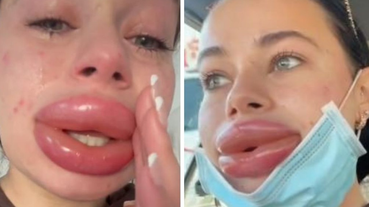 Nieudane zabiegi kosmetyczne: zastrzyki wypełniające usta Jessiki Burko eksplodują