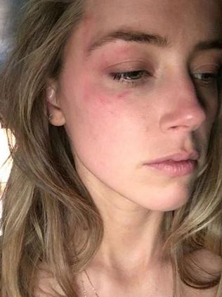 Amber Heard shared this image of her bruised after alleged abuse by Johnny Depp. Picture: Snapchat