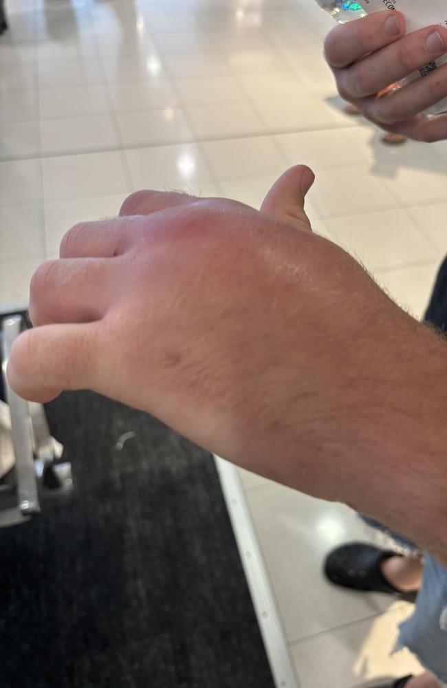 Biggs' left hand looking purple and badly swollen. Picture: Peter Badel