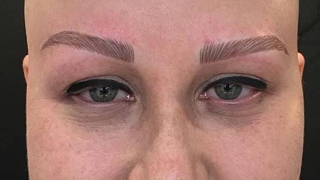 This week Katie Hale had eyebrows tattooed on and she feels a little bit more like the old her.