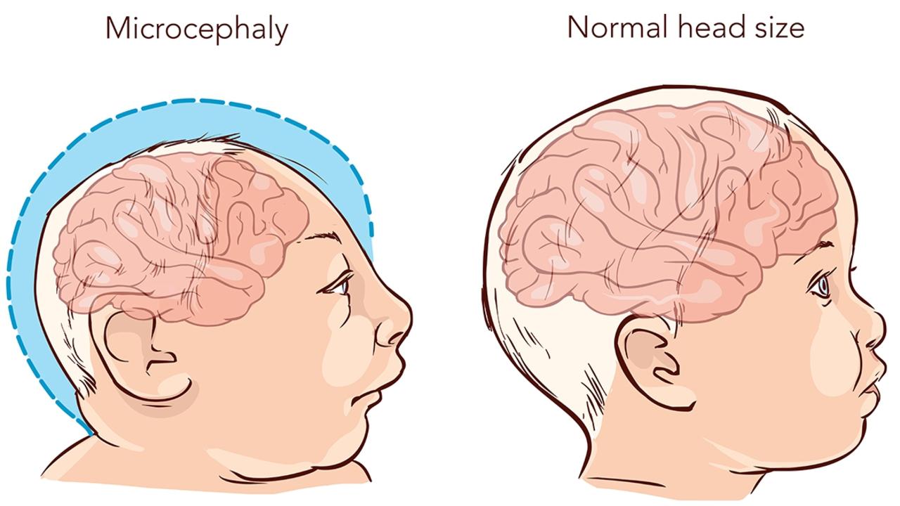 FASD can cause microcephaly, a condition where a baby’s head is much smaller than usual, often due to the brain not growing properly, among other physical and mental disabilities.