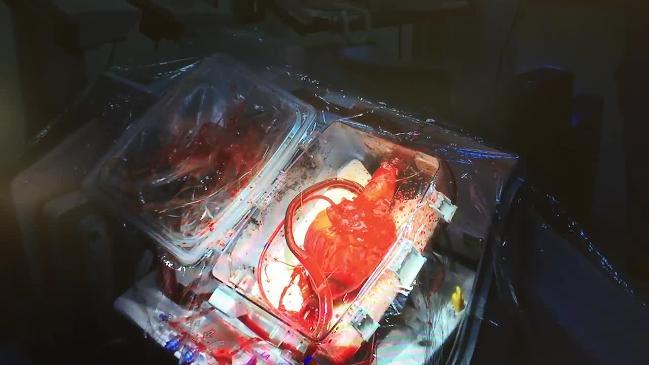 Beating heart- Heart-in-a-box technology