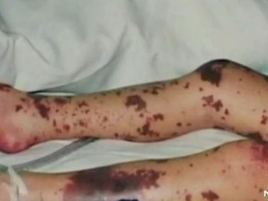 The type of rash experienced by meningococcal sufferers. Picture: 7 NEWS
