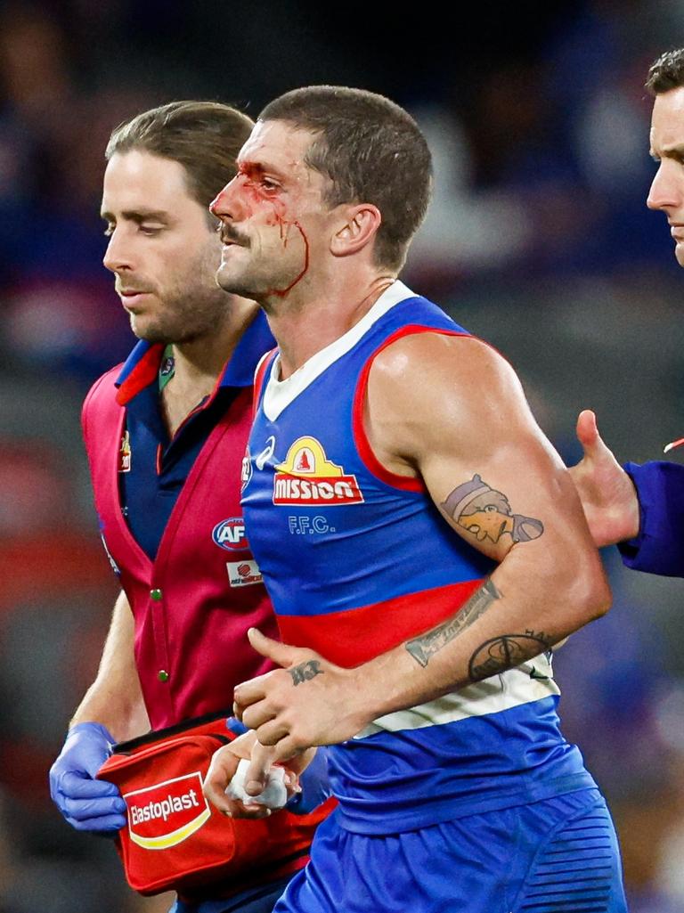 Liberatore leaves the field during Western Bulldogs’ clash with Hawthorn. Picture: Dylan Burns/AFL Photos via Getty Images