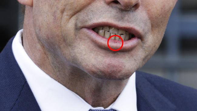 Is this the swollen lip Tony Abbott received? Picture: AAP Image/Jim Rice