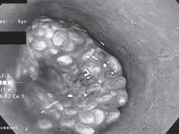 An endoscopy shows impacted chia seeds inside a 39-year-old man’s oesophagus. Picture: The American Journal of Gastroenterology